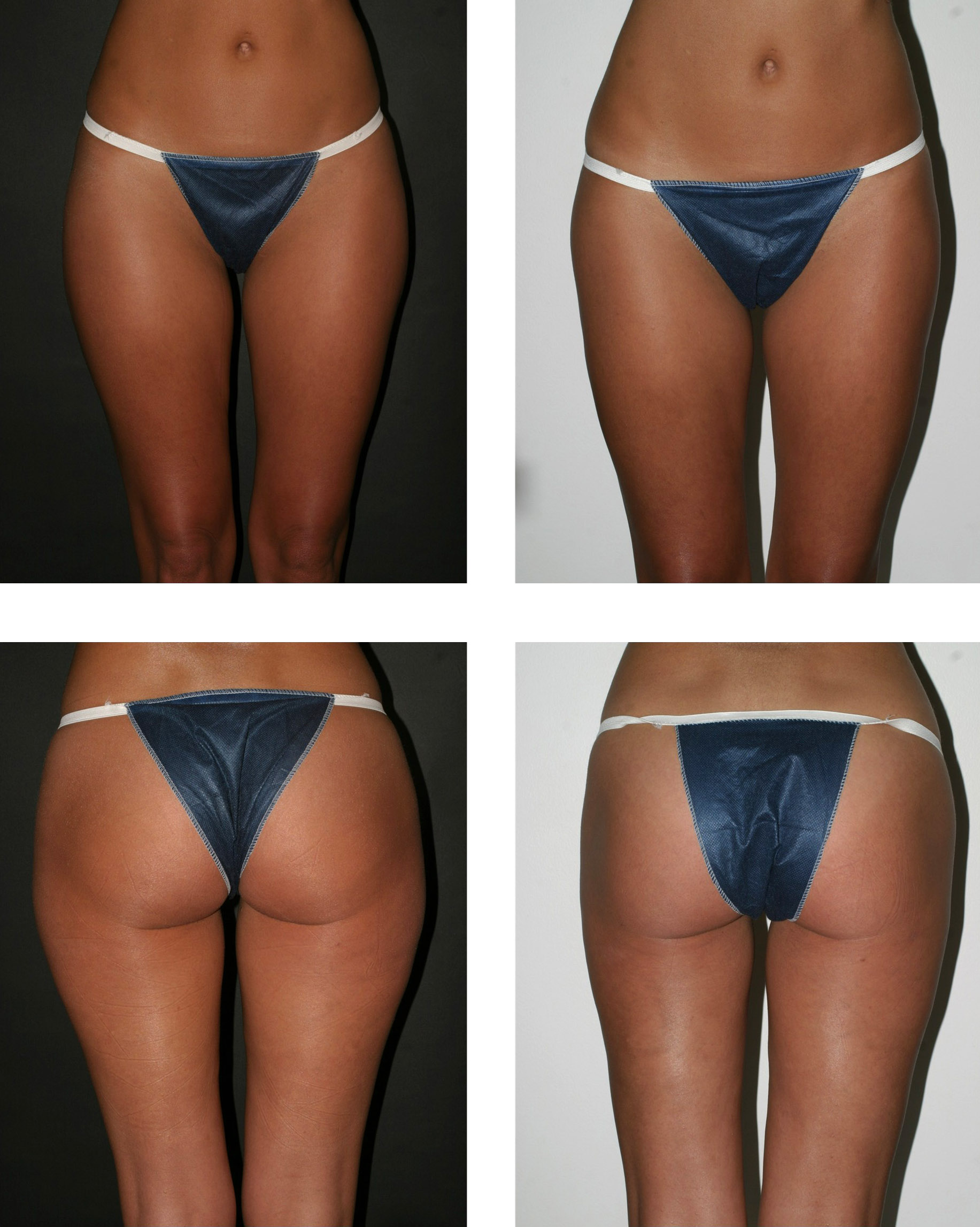 Leg Liposuction Before and After
