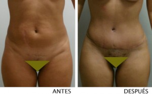 Abdominoplastia (antes y después)